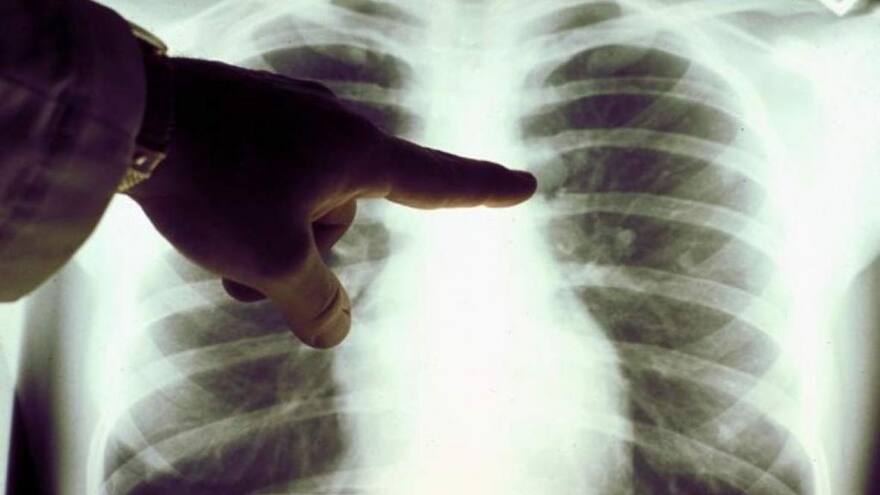 Cáncer de pulmón: Ciencia da un paso hacia la creación de fármacos para combatirlo