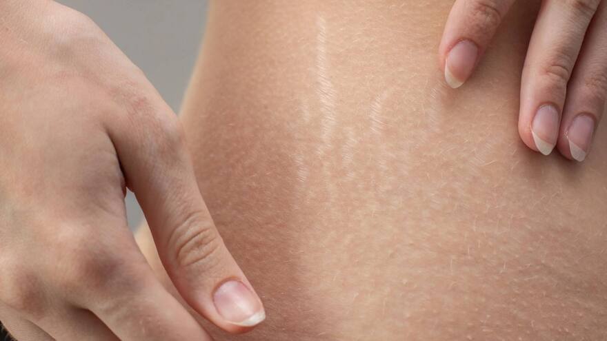 Crema casera para eliminar estrías, aprenda cómo se prepara