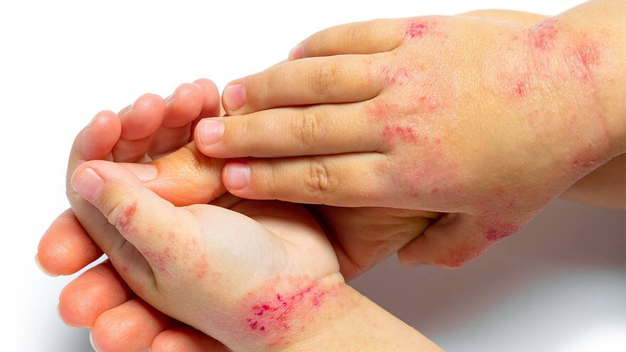 Día de la Dermatitis Atópica: se sitúa entre el 4 y el 20% de la población