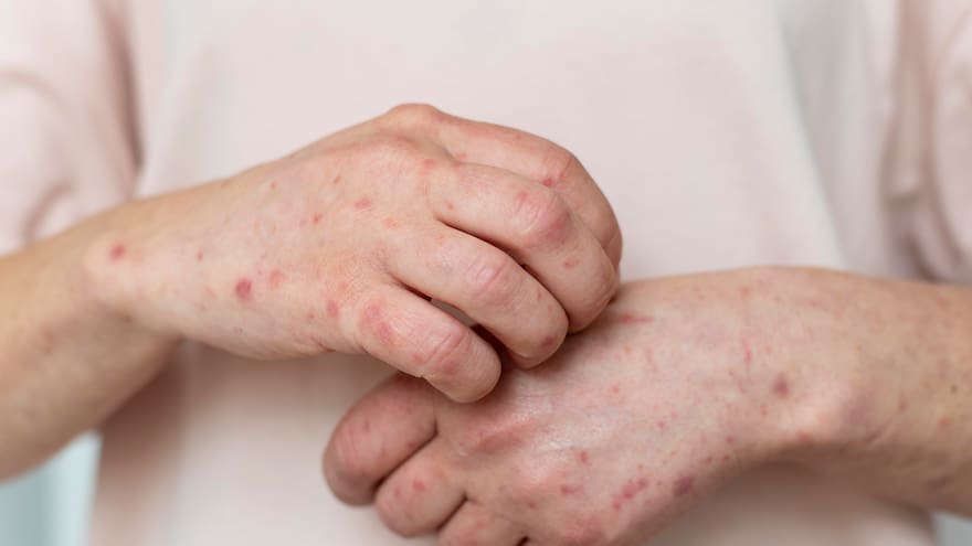 ¿Cómo se transmite el sarampión y cuáles son sus síntomas?: en Colombia fueron confirmados tres casos